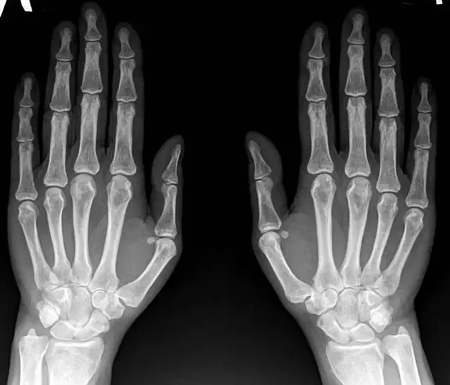 Arthritis vum Handgelenk op Röntgen ier Dir Hondroine benotzt