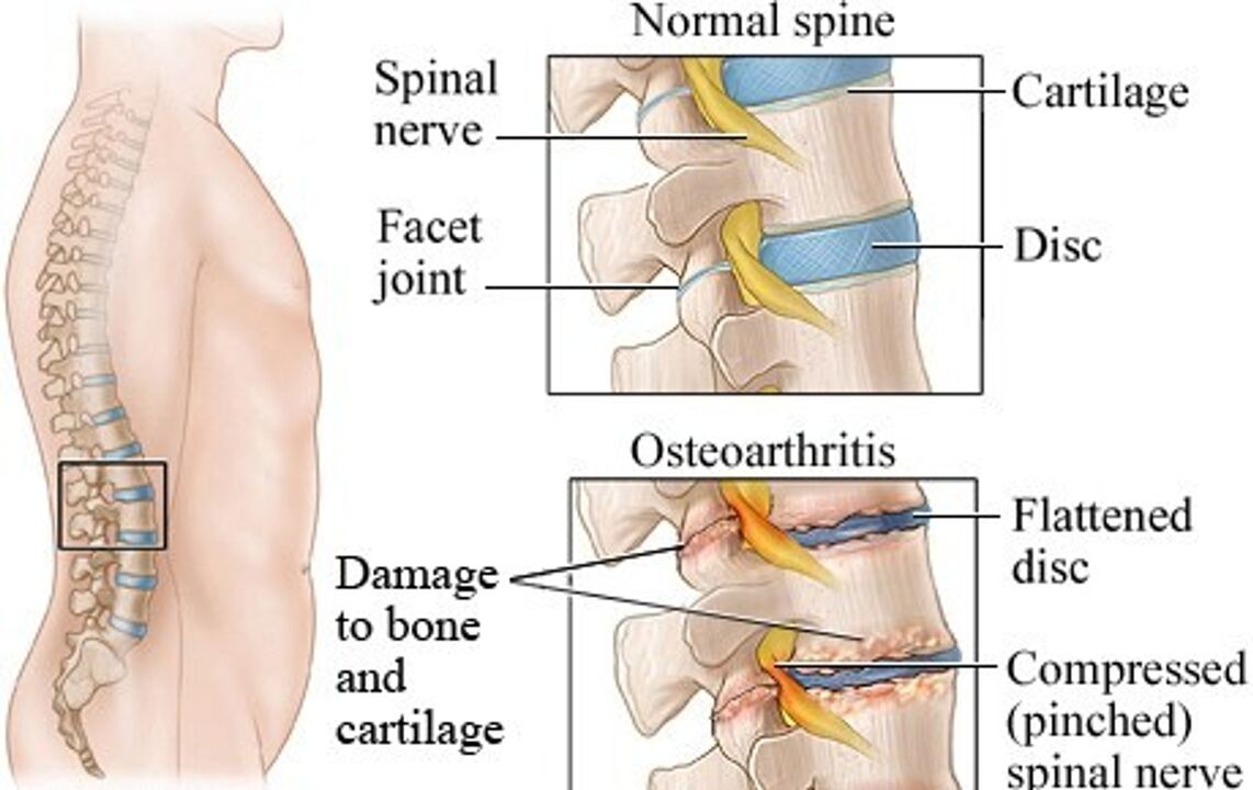 Den Ënnerscheed tëscht engem gesonde Disk an engem Disk mat Osteochendrosis