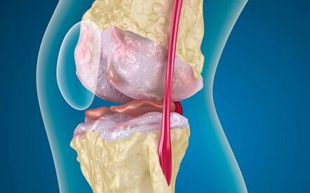 D'Grënn fir d'Entwécklung vu Arthrosis vum Knéi Gelenk