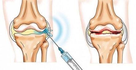 Wéi Dir Arthrosis vum Knéi Gelenk behandelt